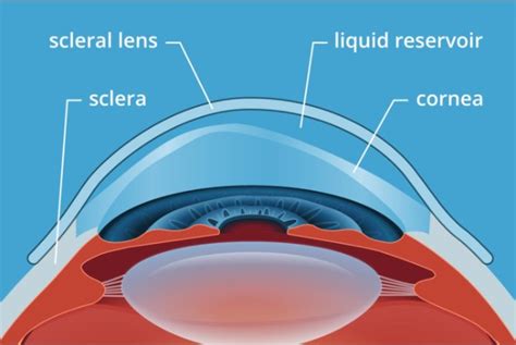 scleral lenses leadington  You can expect to pay anywhere from $500 to $4,000 per lens